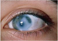  Pengobatan Herbal Glaukoma Yang Alami